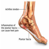 essential-physio-april-2014-plantar-fasciitis