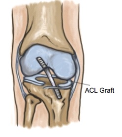 ACL graft